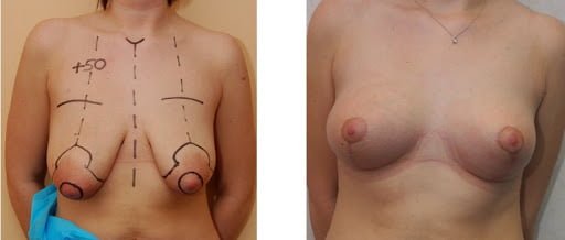Fotografia antes e depois de uma mamoplastia de aumento
