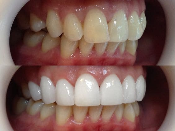 Fotografias de antes e depois de facetas dentárias