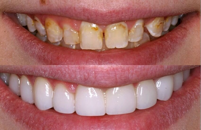 fotografia de antes e depois de facetas dentárias