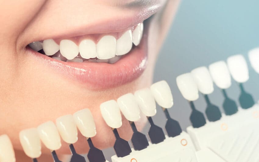 Escolher a cor certa para facetas dentárias