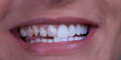 resultados antes e depois de facetas dentárias em Istambul