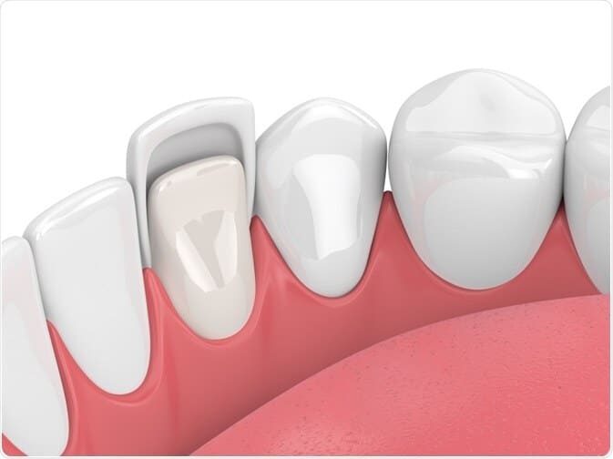 Diagrama para o ajudar a compreender como se coloca uma faceta dentária na Turquia