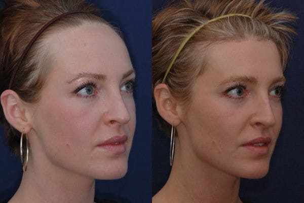 fotografia antes e depois do abaixamento da linha frontal nas mulheres