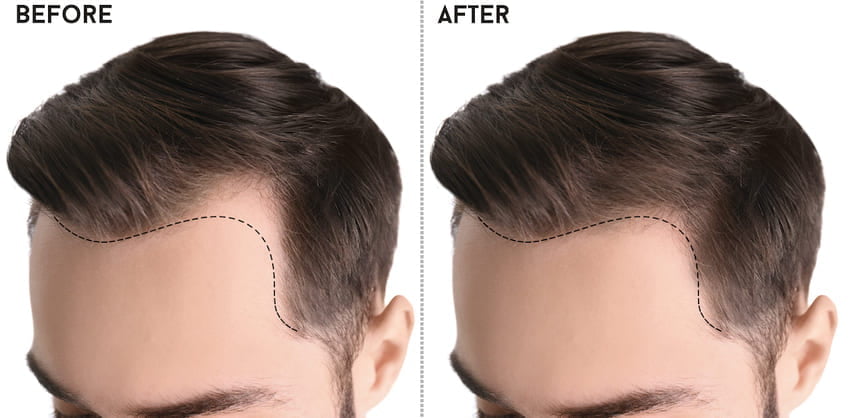 Simulação antes e depois do abaixamento da linha frontal em humanos