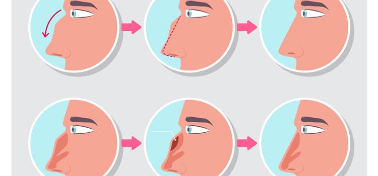 diagrama de rinoplastia