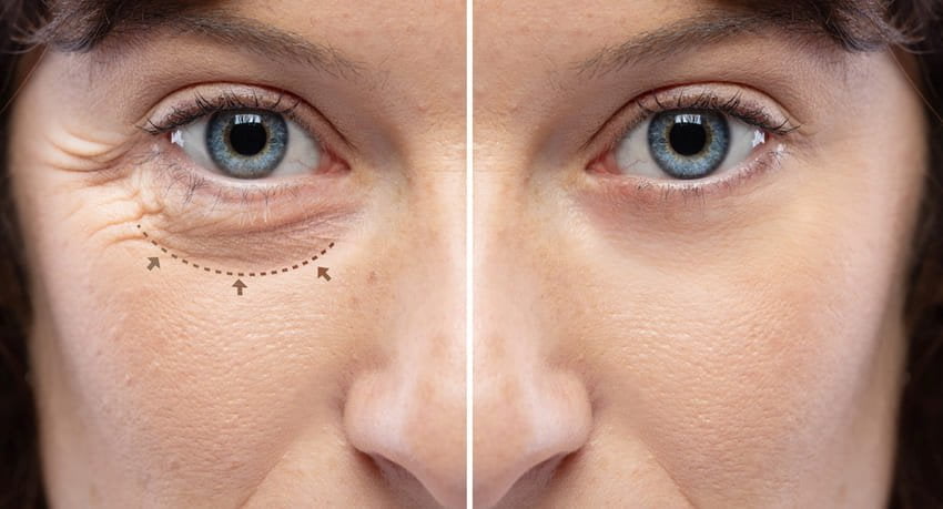 Simulation photo avant et après d'une blépharoplastie