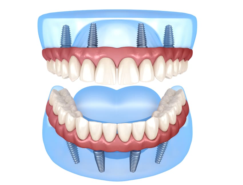 Schéma d'implant dentaire all-on-4