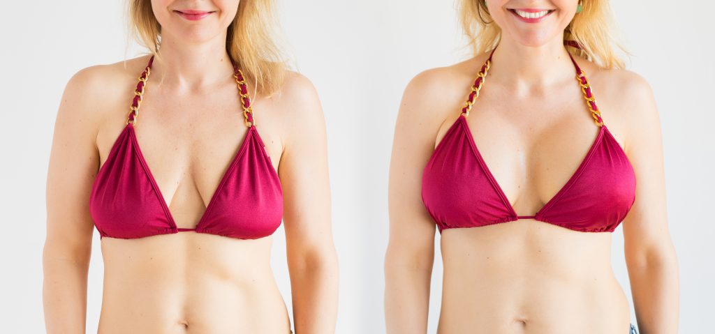 Resultados antes e depois da mamoplastia de aumento