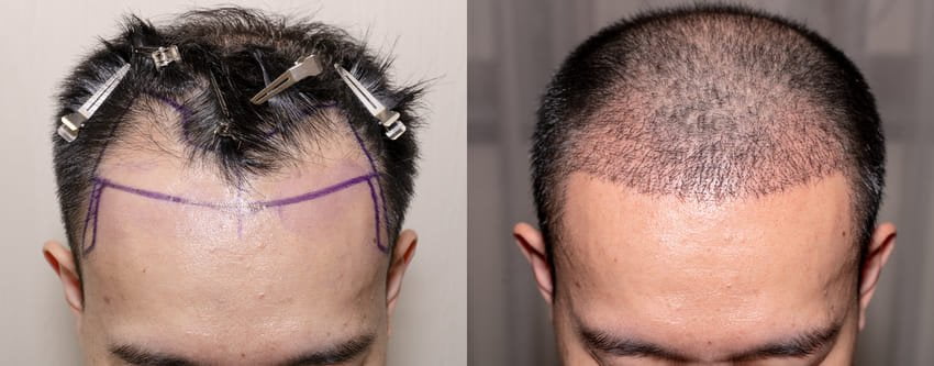 Photo avant et après d'une greffe de cheveux en Turquie