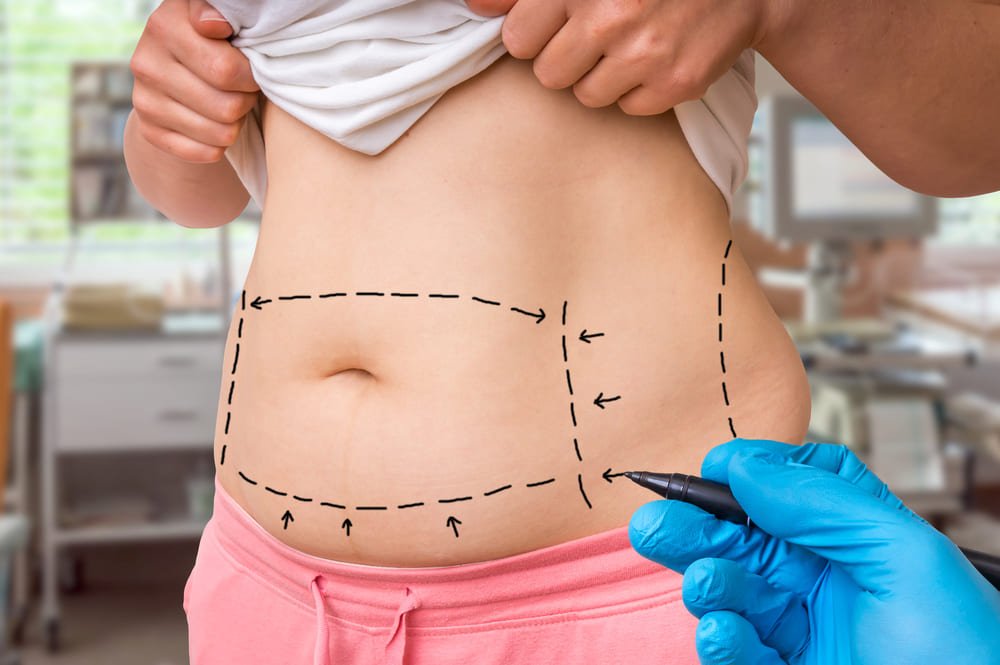 Esquema de lipoaspiração abdominal
