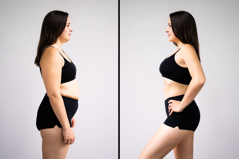 lipoaspiração antes e depois da fotografia em Istambul, Turquia