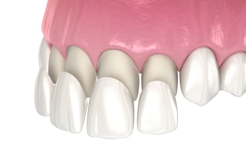 Diagrama explicativo das facetas dentárias