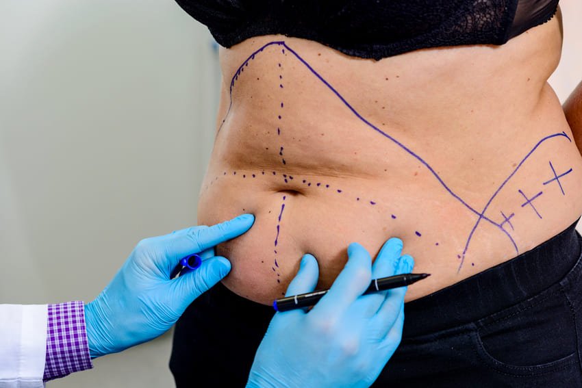 Desenho de um cirurgião numa barriga para abdominoplastia