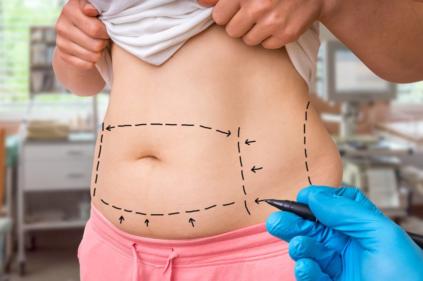 Marca de cirurgião no estômago de uma pessoa ligeiramente gorda