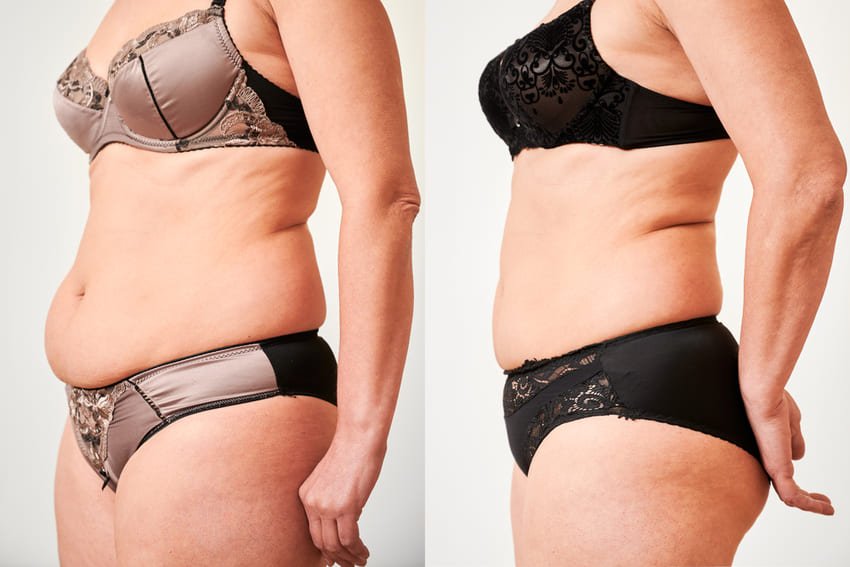 Resultados antes e depois de uma abdominoplastia feminina