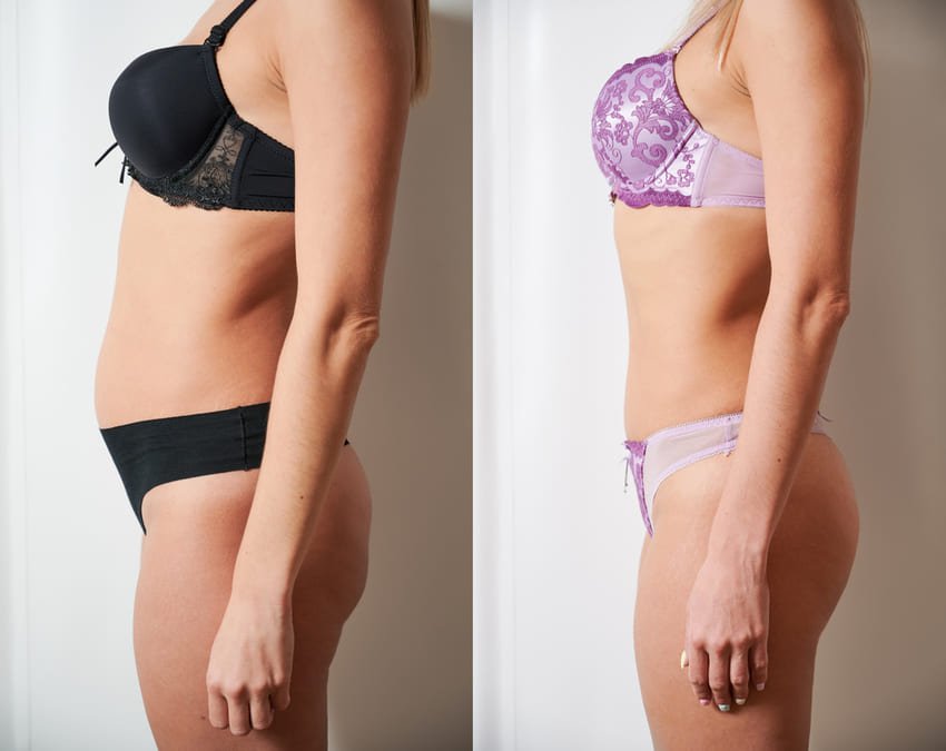 Fotografia de antes e depois de uma mulher submetida a uma abdominoplastia