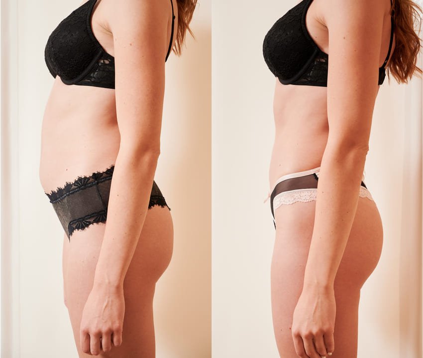 Fotografia de antes e depois de uma mulher submetida a uma abdominoplastia
