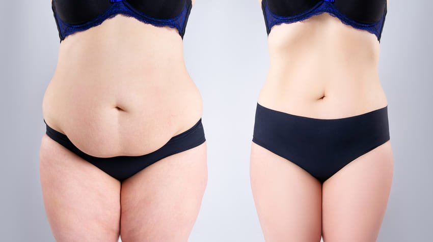 Simulação antes e depois de uma abdominoplastia feminina