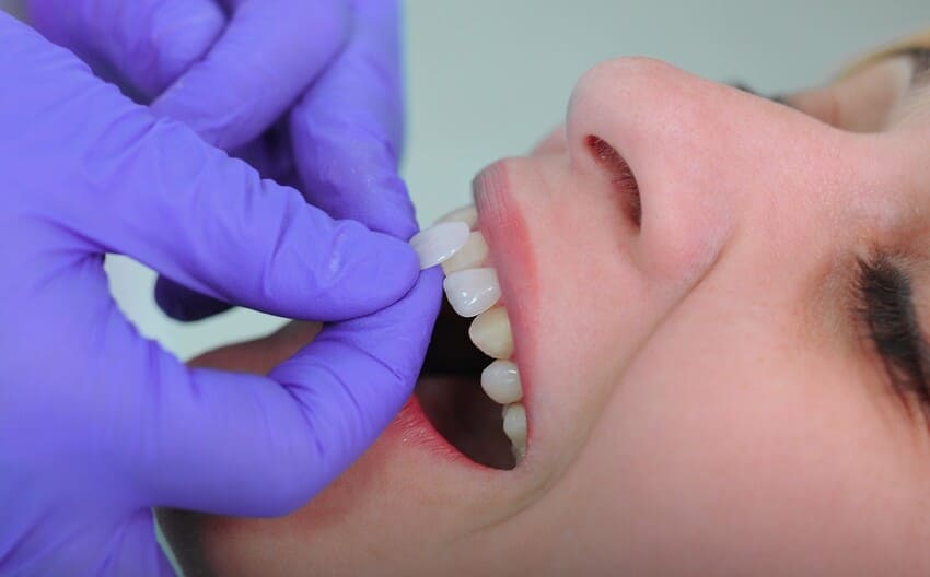 A diferença entre dentes verdadeiros e facetas dentárias
