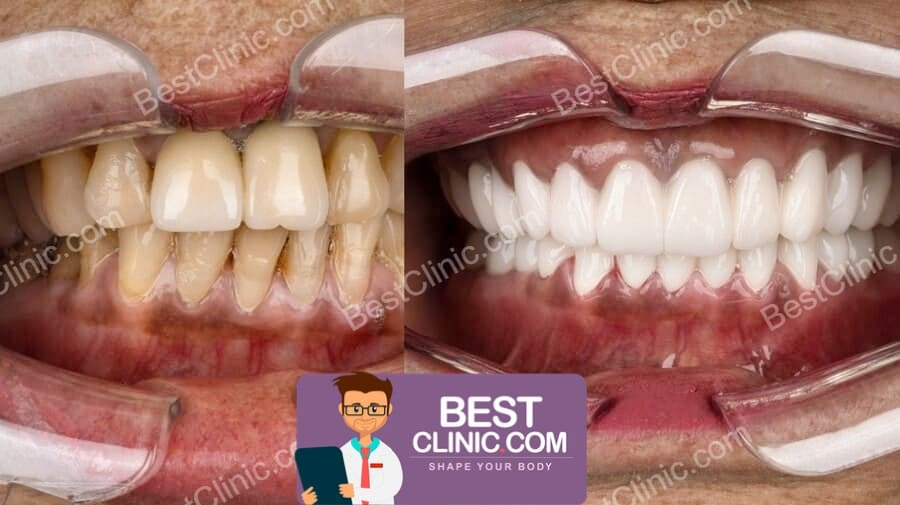 foto antes depois de facetas dentárias na Turquia