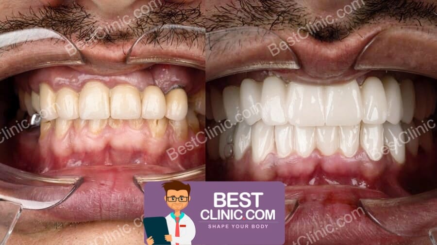 antes e depois de facetas dentárias Turquia
