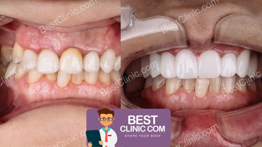 antes e depois de facetas dentárias Turquia