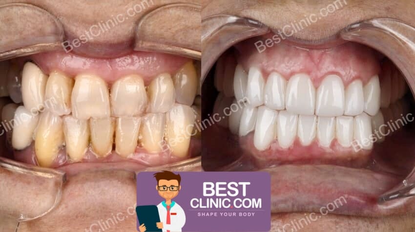antes e depois de facetas dentárias peru