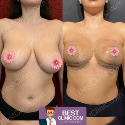 redução mamária antes e depois na Turquia
